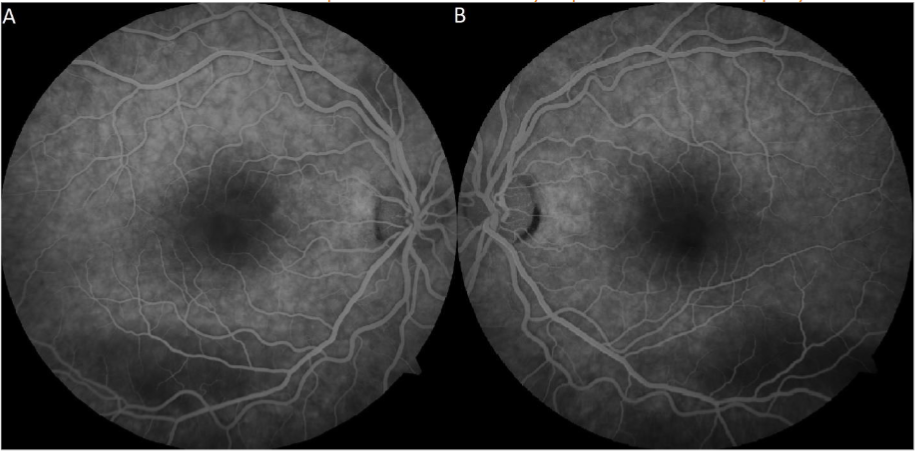 Figure 3: IVFA showed patchy choroidal filling, inferior hypofluorescence corresponding to areas of hypopigmented demarcation and thickened RPE OU, with hypofluorescence of the vitelliform lesion OS (A, B).