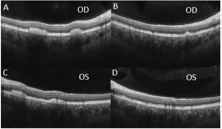 Figure 6: OCT of the macula at 15 months (A, C) and 17 months (B, D) showed improvements in the peripheral vitelliform lesions with correlated reductions in size.