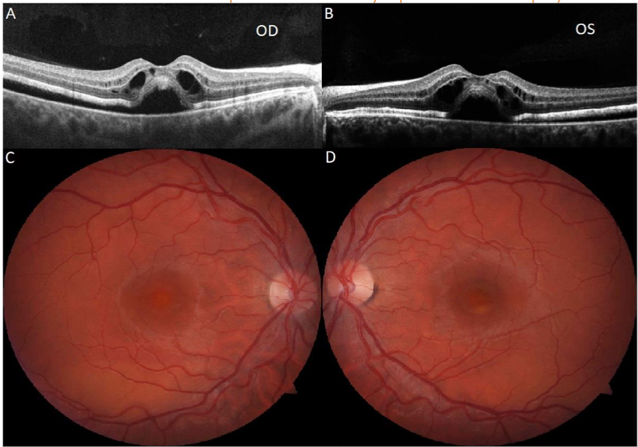 Figure 1: OCT showed SRF, IRC, and shallow NSD with a thickened RPE OU (A, B). Fundus photography showed vitelliform deposits inferior to the fovea OS with serous macular detachments OU (C, D).
