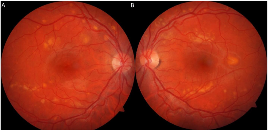 Figure 7: Repeat fundus photography at 1 year and 5 months showed resolved serous macular detachments OU, however with persistent vitelliform deposits along the vascular arcades OU (A,B).