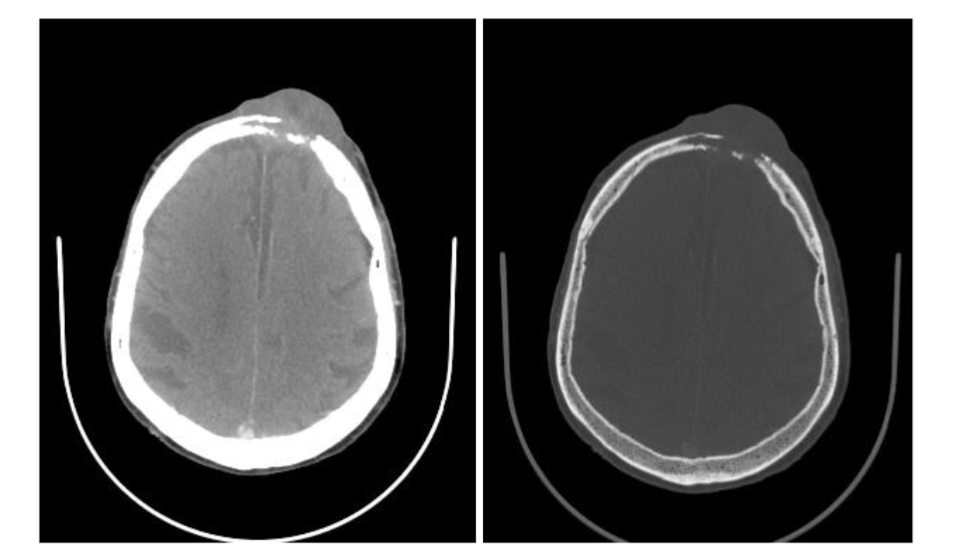 Figure 1. Skin cancer with bone erosions. Axial CT images in the soft tissue (A) and bone windows (B) show a frontal scalp tumor with defect in the underlying skull and intracranial extension.