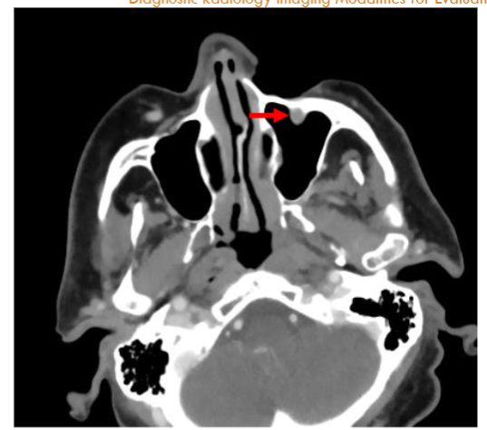 Figure 2. Axial CT image shows a left cheek defect from resected skin cancer and perineural spread of tumor along the left infraorbital nerve (arrow).