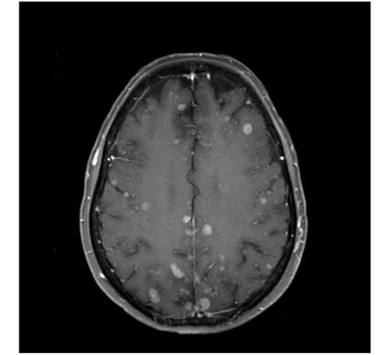 Figure 3. Axial post-contrast T1-weighted MRI shows numerous enhancing tumors in the bilateral cerebral hemispheres from metastatic melanoma.