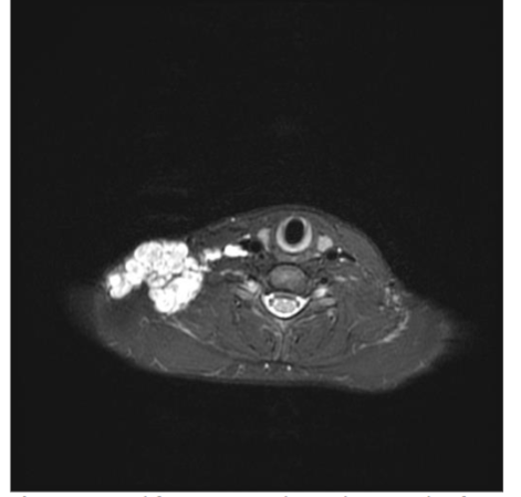 Figure 4. Axial fat-suppressed MRI shows a plexiform neurofibroma extending from the skin of the right lateral neck to the deep spaces.