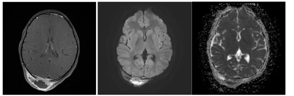 Figure 6. Scalp abscess with epidural inflammation. Axial fat-suppressed post-contrast T1-weighted MRI (A), DWI (B), and ADC map (C) show a rim-enhancing fluid collection in the posterior scalp with restricted diffusion and epidural enhancement.