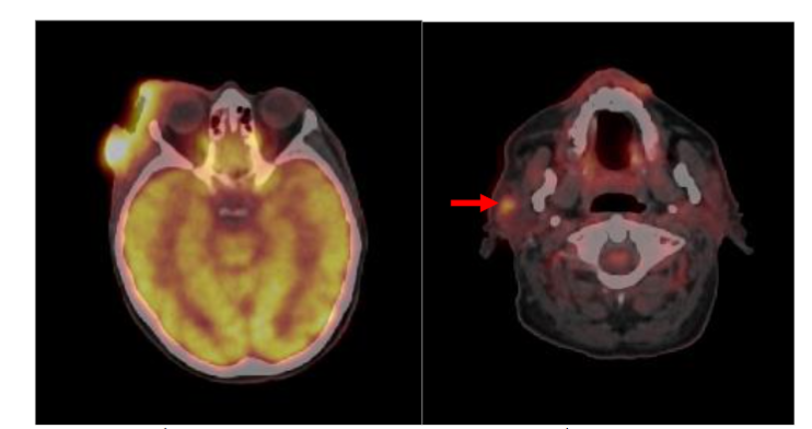 Figure 8. PET/CT for skin cancer staging. Axial 18FDG-PET/CT image show a right face cutaneous tumor and metastatic right parotid lymphadenopathy (arrow).