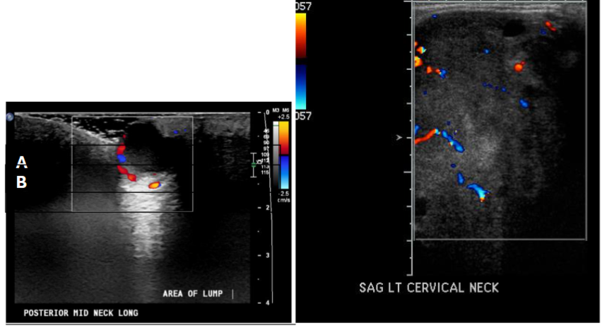 Figure 7. Cystic versus solid lesions on ultrasound. Ultrasound shows a hypoechoic lesion with through transmission associated with a skin abscess, along with surrounding hyperemia (A). Ultrasound shows a mildly hyperechoic mass with internal vascularity that represents a cutaneous neurofibroma (B).