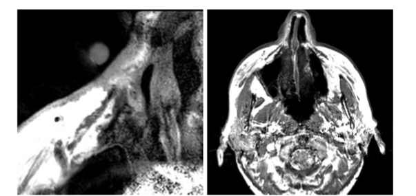 Figure 5. Microscopy coil MRI versus conventional MRI. Axial T1-weighted MRI microscopy image (A) depicts the right nose skin basal cell carcinoma with much higher resolution than the conventional T1-weighted MRI (B).