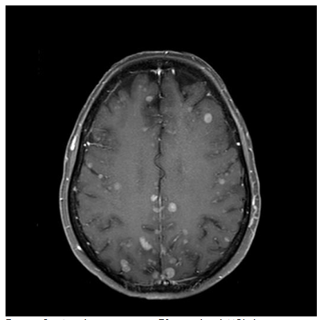 Figure 3. Axial post-contrast T1-weighted MRI shows numerous enhancing tumors in the bilateral cerebral hemispheres from metastatic melanoma.