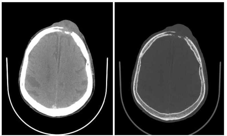 Figure 1. Skin cancer with bone erosions. Axial CT images in the soft tissue (A) and bone windows (B) show a frontal scalp tumor with defect in the underlying skull and intracranial extension.