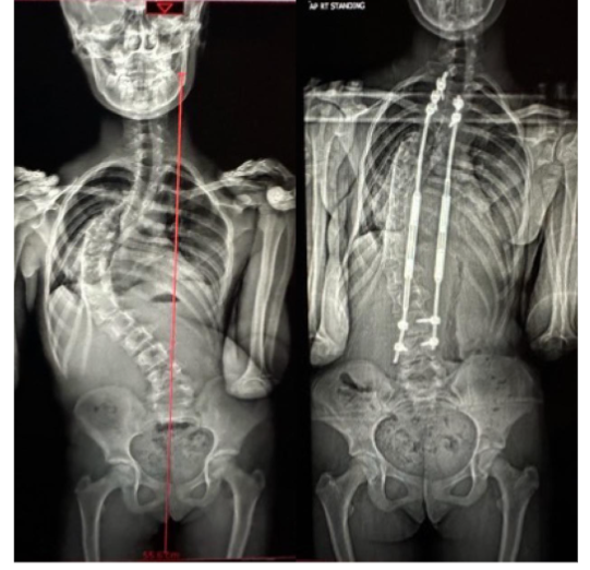 Figure 1: Whole spine EOS images of a patient in the study pre-operatively, and at 2 years post-op. Left image shows pre-op Whole spine Xray with Central Sacral Vertical Line (CSVL, red line showing coronally decompensated curve) with a right sided idiopathic major thoracic curve in a pre-pubertal patient. Right image showing proximal and distal anchors with MCGR rods in situ and a well balanced, corrected curve at 2 years.
