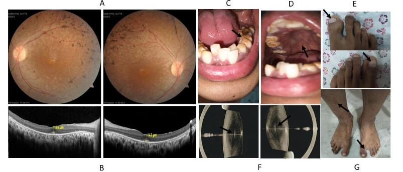 Figure 1: Characteristic features of Heimler syndrome and Infantile Refsum Disease. A. Retinal fundus picture depicting both eyes' bony spicules along the peripheral retina. B. Optical coherence tomography revealed a thinned-out outer nuclear (photoreceptor layer) and outer plexiform layers. C. Amelogenesis imperfecta. Malformation of primary and secondary teeth with reduced enamel volume and hypo mineralization. D. High-arched palate with torus palatinus. E. Beau's line and punctate leukonychia were detected in both big toes. F. Anterior picture showing developmental nuclear cataract in both eyes of the proband. G. Ichthyosis, hyper-pigmented skin rashes, and hallux varus deformity were seen in the legs.