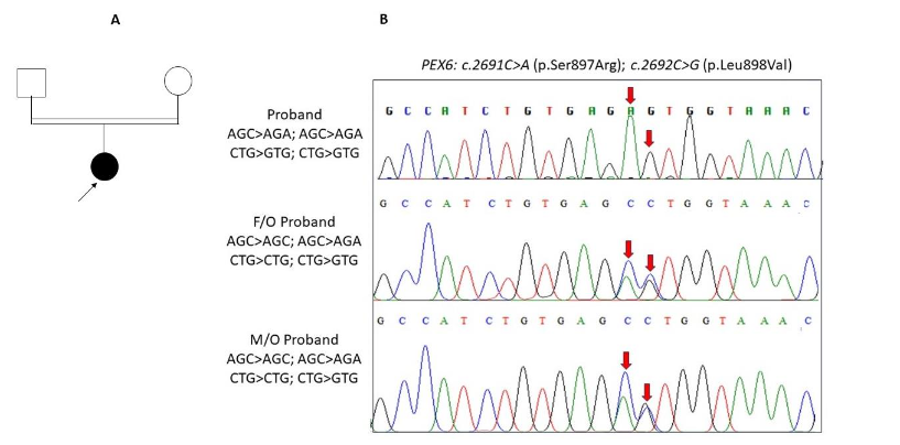 Figure 2: Electropherogram of the Family segregation analysis. A. Pedigree of the proband born out of consanguinity. B. Electropherogram report of the proband with two adjacent novel variations in the PEX6 gene and the family segregation analysis revealing the wild type and the mutant allele of father and mother concomitantly at c.2691 and c.2692 positions.