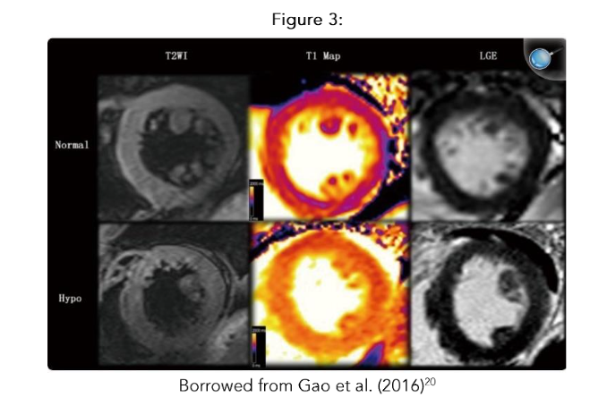 Cardiac MRI comparing patient with severe hypothyroidism.