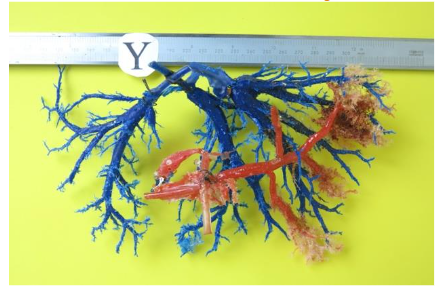 Fig. 4 Cast showing signs of thrombosis of the main branches of the portal vein (red), where only a secondary right branch remains (posterior view).