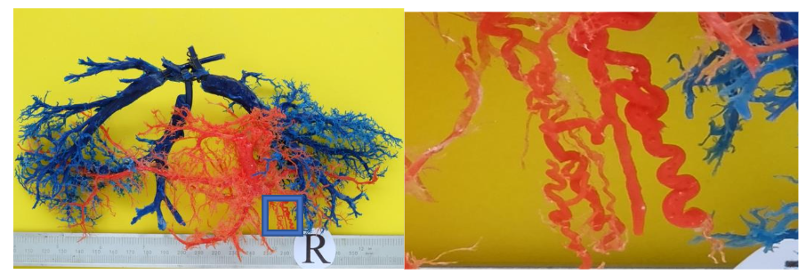 Fig. 5 Great dissociation between the portal venous (red) bed (very reduced, due to thrombosis of the main branches) and the hepatic veins (blue). In detail, venules with a corkscrew appearance.