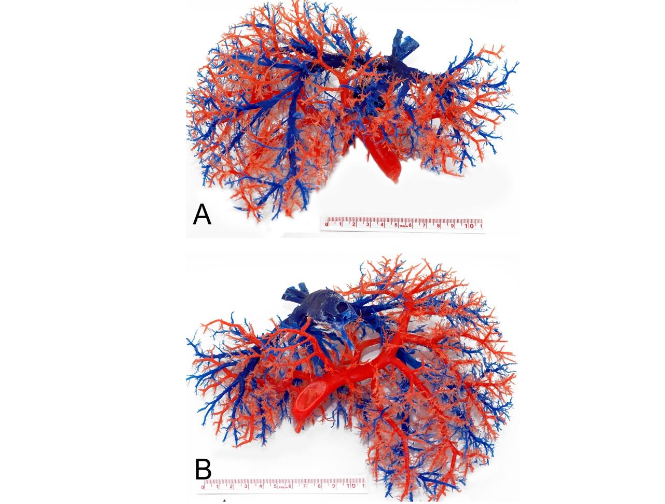 Fig. 1 Resin cast of the venous circulation of the liver seen from the anterior (A) and posterior (B) surfaces. Hepatic veins in blue and portal vein in red (Vasconcelos-Filho et al).