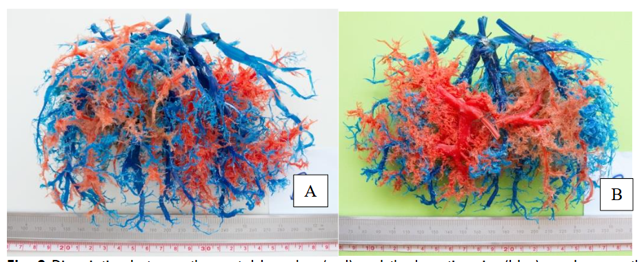 Fig. 2 Dissociation between the portal branches (red) and the hepatic veins (blue) can be seen throughout the liver. Anterior (A) and posterior (B) views.