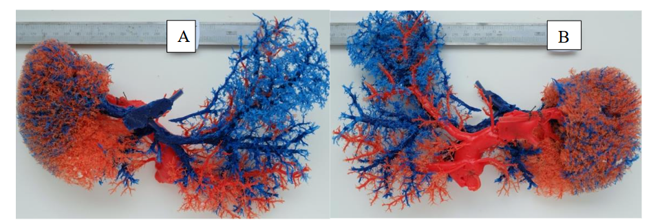 Fig. 3 Dissociation between the portal branches (red) and the hepatic veins (blue) can be seen in the left lobe of the liver. Anterior (A) and posterior (B) views. Large dilation of the intrahepatic branches of the portal vein.