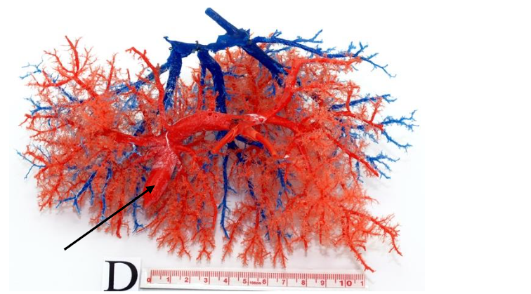 Fig. 6 Cast with dilated portal branch (arrow), which communicated with systemic vein (posterior view) (hepatic veins in blue).