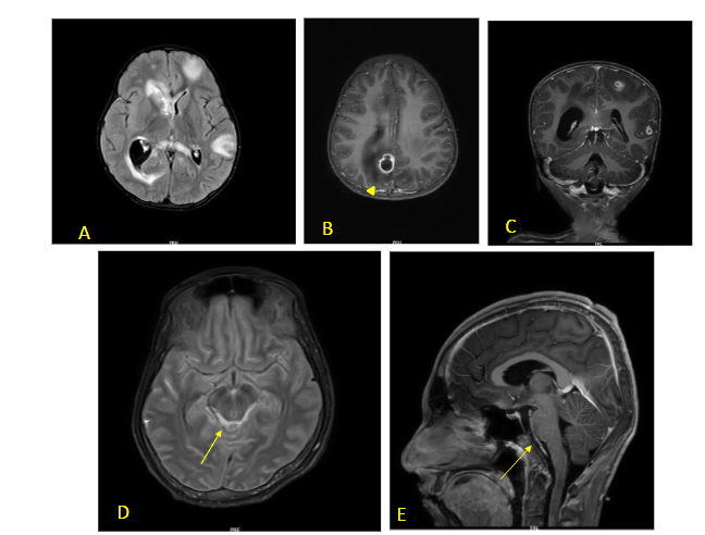 Fig 3. (A-D) Acute Leukoencephalopathy with restricted diffusion (ALERD)- Axial brain MRI demonstrating restricted diffusion – cytotoxic oedema on DWI and corresponding low signals on ADC in bilateral cerebral hemispheres, with sparing of the central perisylvian regions. Axial brain MRI showing diffuse restricted diffusion – cytotoxic oedema on DWI and corresponding low signals in the bilateral cerebral hemispheres.