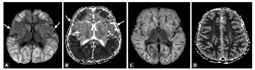 Fig 5 (A-F) – Acute necrotising encephalopathy of childhood (ANEC) in a 12-month-old child with viral gastroenteritis 2 days prior to rapid decline in sensorium. Classical ‘Trilaminar’ sign noted in the T1 and T2 axial images in bilateral thalami, hyperintensities also present in cerebellum and periventricular regions with restricted diffusion on DWI and blooming on SWI (s/o micro-haemorrhages). MR spectroscopy did not show inverted lactate doublet.