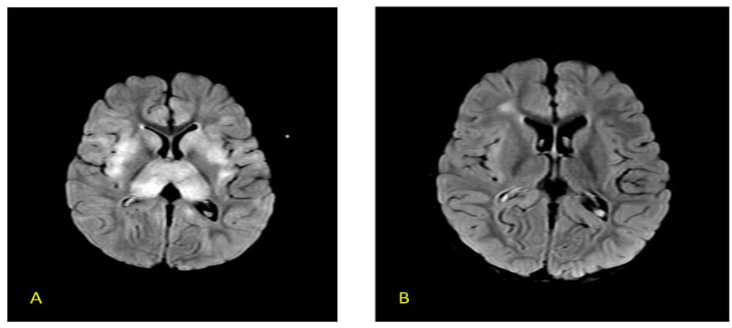 Fig 8 (A-B) Axial CT scan in a 7-year-old with AFCE showing diffuse cerebral edema with ‘white’ cerebellum sign (reversal) – prognosis is very poor in this case.