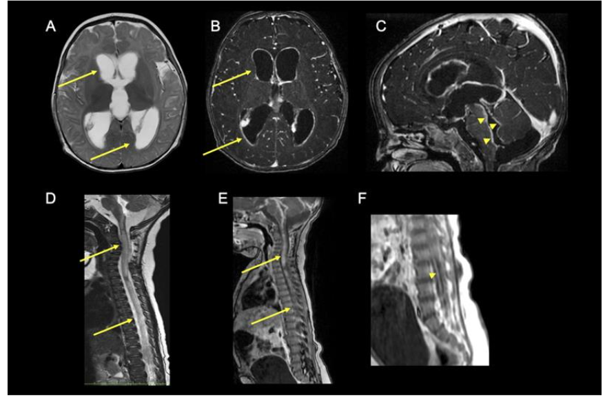 Fig. 1 (A-E): Listeria in a 4-month-old. Axial T2 and Contrast images demonstrate hydrocephalus, ventriculitis and leptomeningitis in the sulcal spaces, lining the brainstem and cerebellum. T2 sagittal spine demonstrates long segment cord myelopathy - T2 hyperintensities. Contrast spine sagittal depicts extensive intramedullary and cauda equina nerve root enhancement.