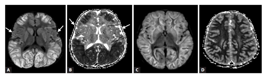 Fig 5 (A-F) – Acute necrotising encephalopathy of childhood (ANEC) in a 12-month-old child with viral gastroenteritis 2 days prior to rapid decline in sensorium. Classical ‘Trilaminar’ sign (arrow) noted in the T1 (A) and T2 (B-D) axial images in bilateral thalamic, hyperintensities also present in cerebellum and periventricular regions with restricted diffusion on DWI (E) and blooming on SWI (F) (s/o micro-haemorrhages). MR spectroscopy did not show inverted lactate doublet.