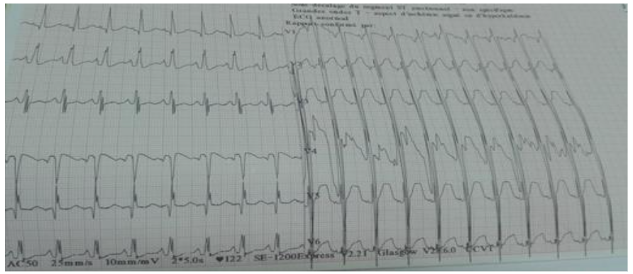 Electrocardiogram showing left ventricular hypertrophy with repolarization disorder and biphasic T wave