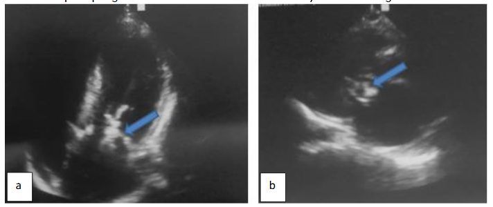 Transthoracic ultrasound centered on the left ventricle: longitudinal (a) and axial (b) views at the mitral orifice showing mitral valve anterior leaflet voluminous vegetation (blue arrow)