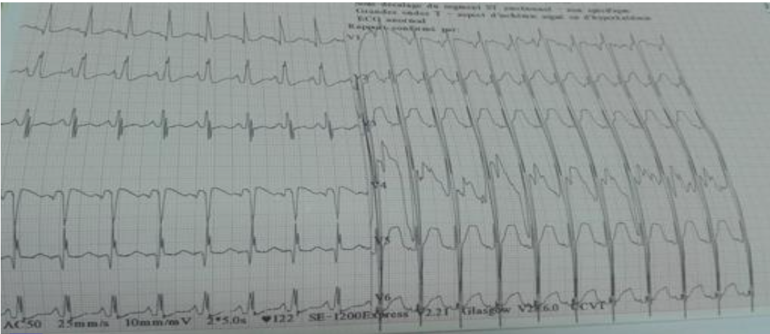 Figure 1: Electrocardiogram showing left ventricular hypertrophy with repolarization disorder and biphasic T wave
