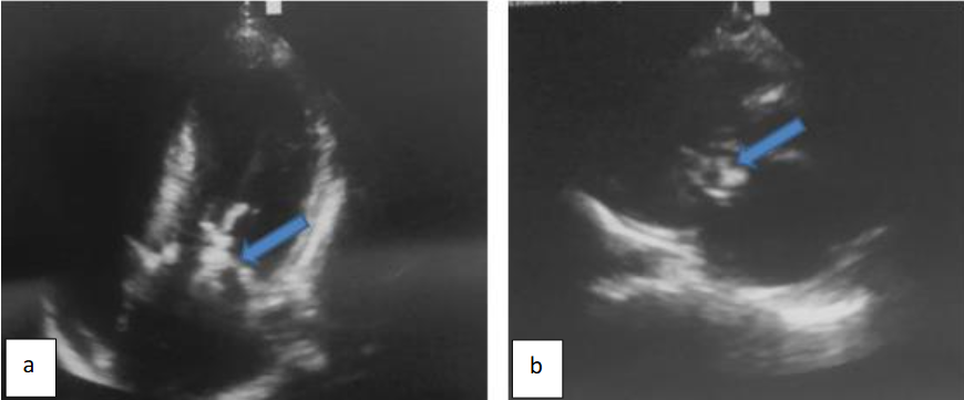 Figure 3: Transthoracic ultrasound centered on the left ventricle: longitudinal (a) and axial (b) views at the mitral orifice showing mitral valve anterior leaflet voluminous vegetation (blue arrow)