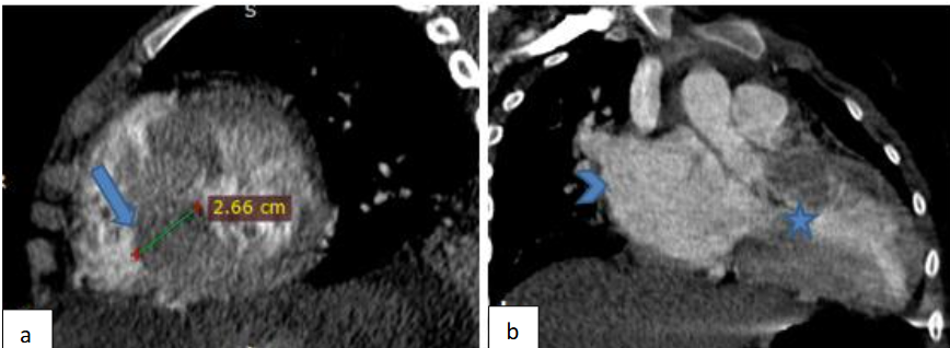 Figure 5: Cardiac CT angiography: short axis (a) and sagittal oblique (b) demonstrating marked thickening of the ventricular septum reaching up to 27mm, (arrow) with left ventricular narrowing (star) and left atrial dilatation (arrow head)