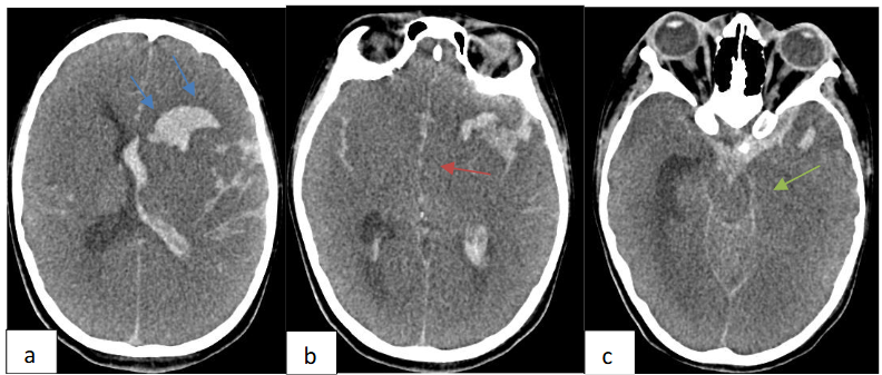 Figure 6: Plain brain CT scan: a. Left frontal intra axial hematoma (blue arrow) with intra ventricular extension and subarachnoid haemorrhage. b. Consequent diffuse brain edema with subfalcine herniation (red arrow) and c. left uncal herniation (green arrow)