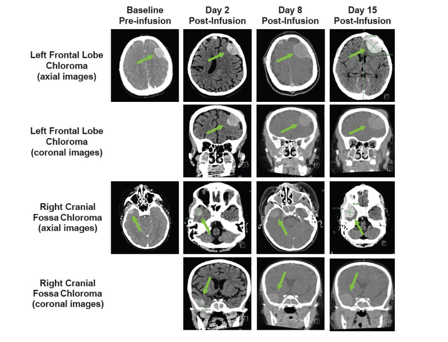 Figure 3. Cranial PET-CT and CT scans showing progressive swelling at known sites of extramedullary disease. Baseline pre-infusion (PET-CT) and post-infusion (CT) scans are shown. Arrows indicate sites of extramedullary disease; CT, computed tomography; PET, positron emission tomography.