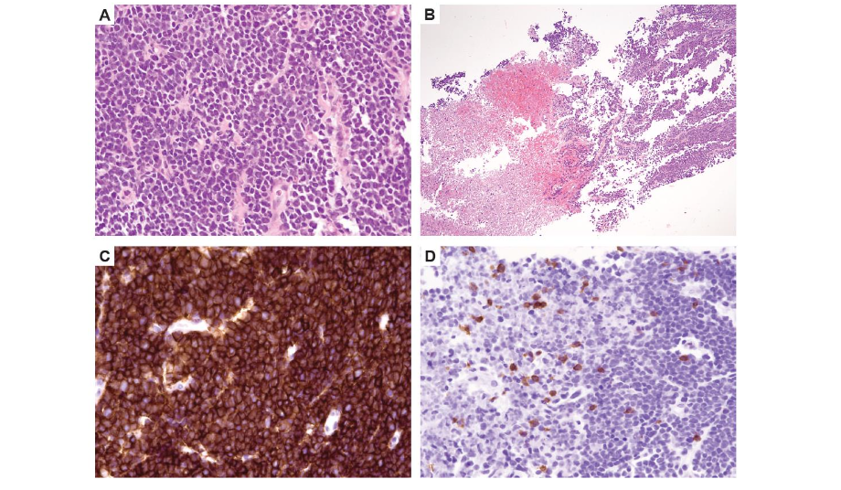 Figure 5. Left and right inguinal CT scans (axial images) showing progressive swelling of known sites of extramedullary disease.