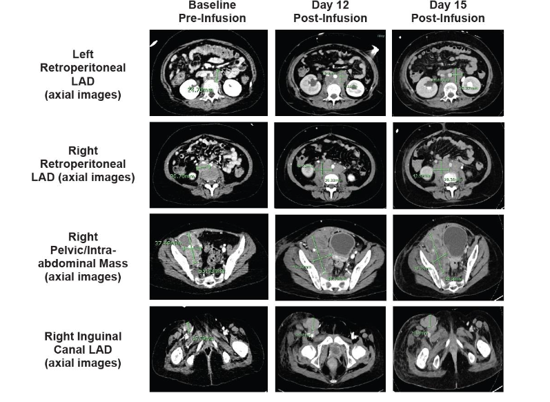 Figure 4. A. Baseline and post-infusion CT scans show marked progression of known retroperitoneal disease. Baseline pre-infusion (CT) and post-infusion (CT) scans are shown. Arrows indicate areas of known retroperitoneal disease; CT, computed tomography.