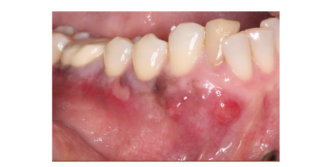 Figure 1. Preoperative clinical photo showing soft tissue lesions in the mucosa associated with tooth #26 and 27.