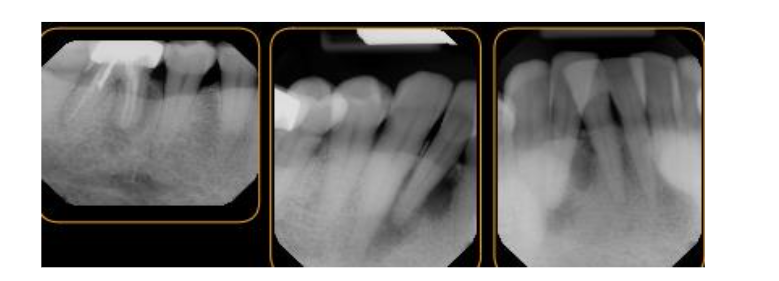 Figure 2. Preoperative intraoral periapical radiograph taken to show bony contour from teeth #23 to tooth #31. A large low dense bone noted around #26 that extended from alveolar ridge to apex of the teeth #26 and 27. In addition, radiograph showed an endodontic lesion at the apex of #30.