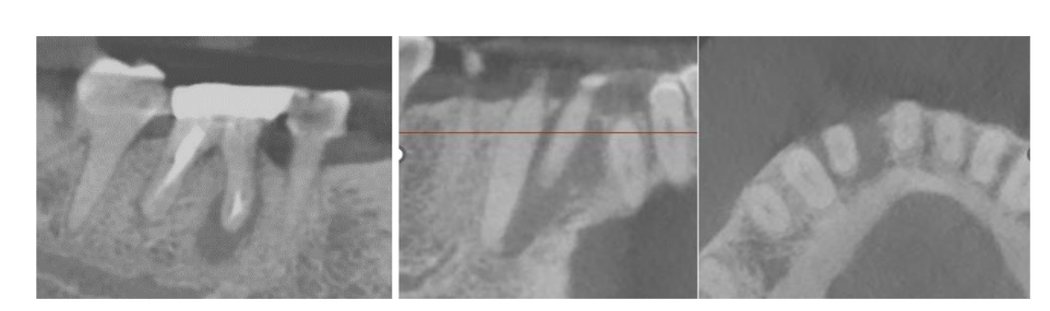 Figure 3. 3-D imaging of the lower right region disclosing magnitude of bony defect in bucco-lingual and occluso-gingival dimension in the area of #26, which could not be disclosed by 2-D imaging. In addition, failing endodontic treatment of tooth #30 is self-explanatory.