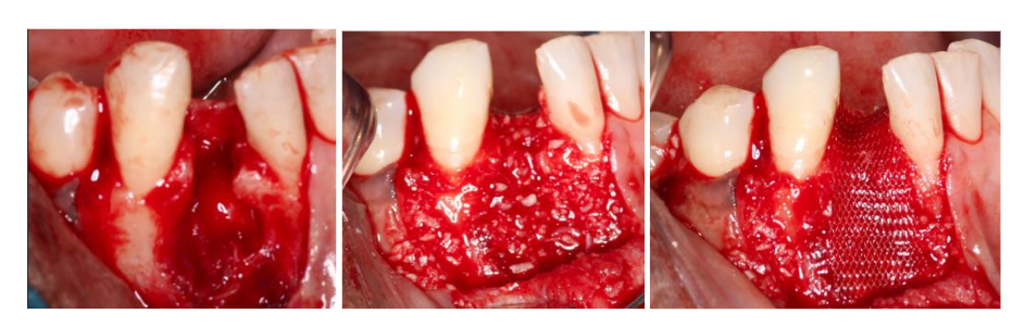 Figure 4. Surgical photos following removal of tooth #26, showing enucleation of a large cyst measuring approximately 18 mm in length and 8 mm in width. Reconstruction of the bony defect performed by the guided bone regeneration along with bioabsorbable membrane, which improved prognosis of the neighboring teeth #25 and 27 in addition to fill in the bony defect of the #26.