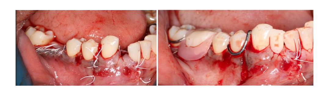 Figure 5. Showing flap closure using the 4.0 PTFE sutures and delivery of a temporary partial denture replacing missing #26 and 30.