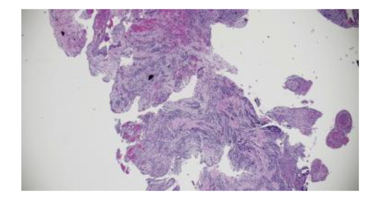 Figure 6. Histopathology confirmed a Radicular Cyst (K04.8), ruling out malignancy. Pathologist reported H&E-stained soft tissue section consists of loose fibrovascular connective tissue containing a mixed but predominantly chronic inflammatory infiltrate associated with nests and anastomosing cords of mildly hyperplastic stratified squamous epithelium.