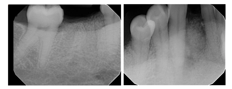 Figure 7. Post treatment radiography, 6 month later showed significant improvement of osseous defect.