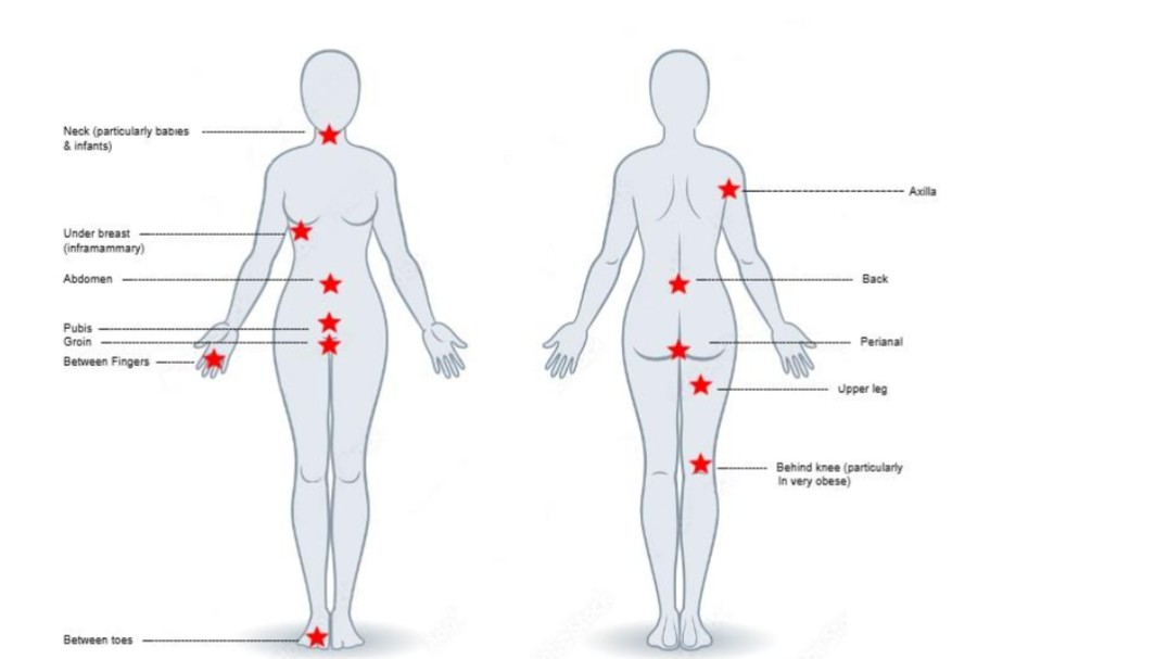 Figure 1: The common locations for intertriginous dermatitis