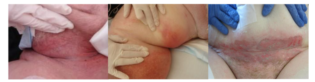 Figure 2: Intertriginous Dermatitis of the neck, behind the knee and abdomen. The abdominal case is more extensive with crusting