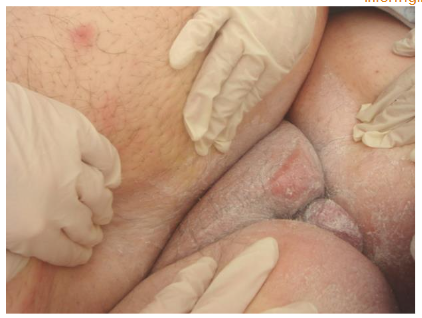 Figure 5: The examiner will need assistance to move skin folds in the morbidly obese patient