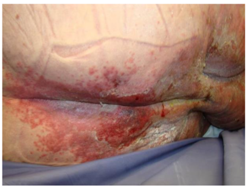 Figure 6: This patient has several skin conditions including candidiasis, blistering deep tissue pressure injury on the lower gluteal folds, incontinence associated dermatitis and retained zinc oxide and fecal matter on the skin