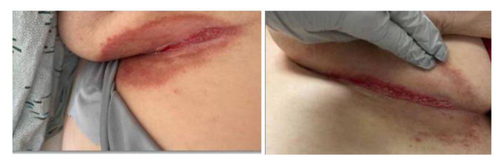 Figure 7: Resolution of submammmary ITD with moisture wicking textiles that contain silver threads